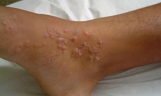 Giun chi chít, gồ ghề dưới da suốt 2 năm nhưng không hay biết